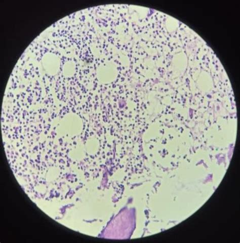 Tuberculosis Medular VIH SIDA Pancitopenia Aspirado Medula Osea