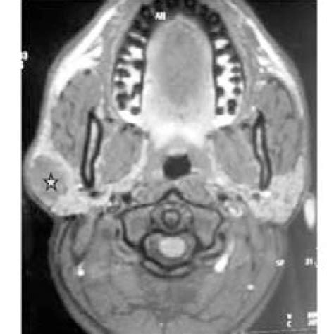 Parotid Mri Axial T1 Weighted Section Showing Right Parotid Lesion In