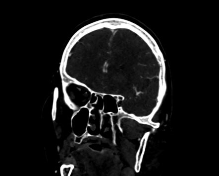 Normal Head Ct Angiogram Image Radiopaedia Org