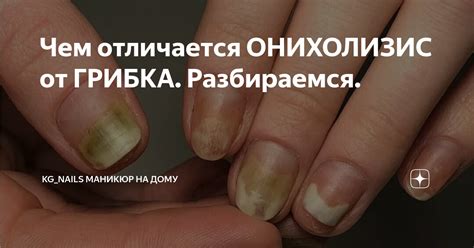 Чем отличается ОНИХОЛИЗИС от ГРИБКА. Разбираемся. | KG_nails маникюр на ...