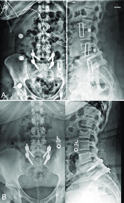 A Upright Postoperative Anteroposterior Left And Lateral Right Download Scientific Diagram