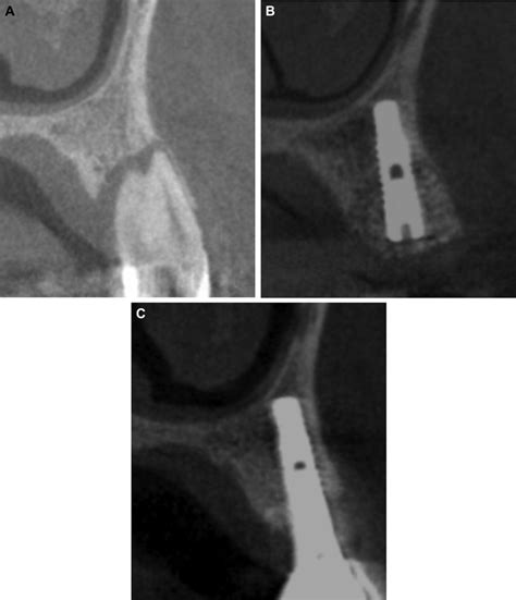 Cone Beam Computerized Tomographic Follow Up Of Case A Cone Beam