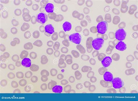 Group Of Blast Cells In Leukemia Background Stock Photo Image Of