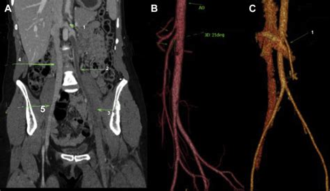 Nutcracker Syndrome And Deep Venous Thrombosis In A Patient With