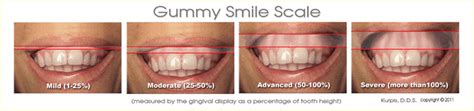 Gummy Smiles Medical Orofacial Surgery