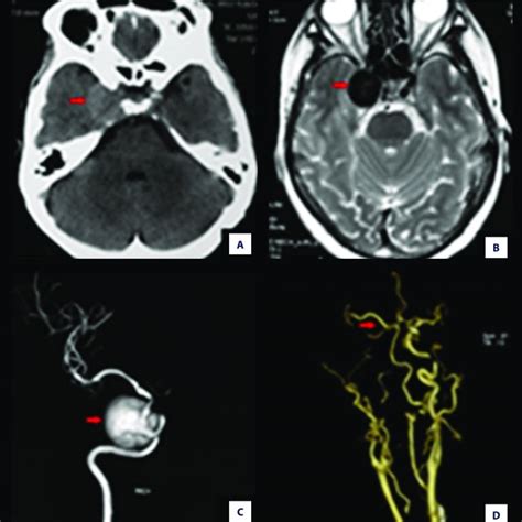 Isolation Of Left Inner Carotid Artery Intracavernous Aneurysm Coupled