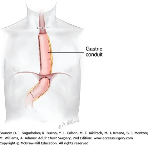 Minimally Invasive Esophagectomy | Thoracic Key