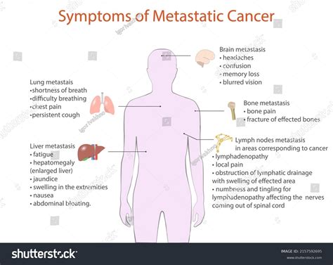 Symptoms Metastatic Cancer Vector Medical Diagram Stock Vector (Royalty Free) 2157592695 ...