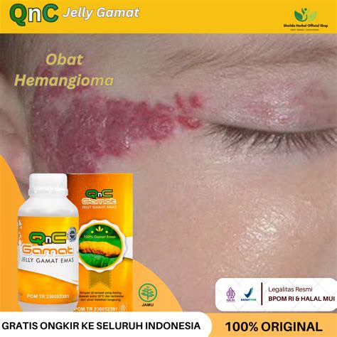 Jual Obat Hemangioma Penghilang Tanda Lahir Merah Bayi Bercak Mongol