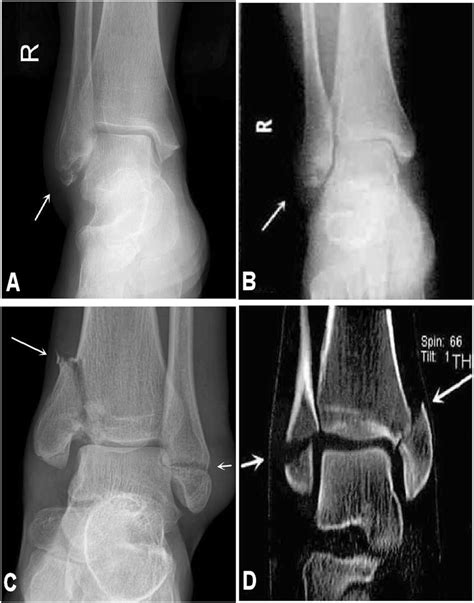 Medial Malleolus Fracture Splint