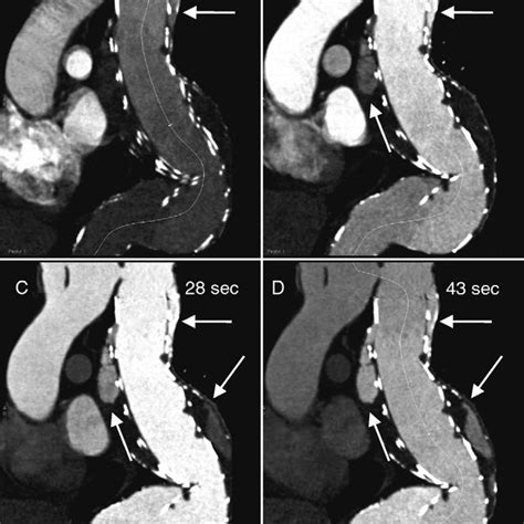 Pdf Time Resolved Ct Angiography For The Detection And Classification Of Endoleaks