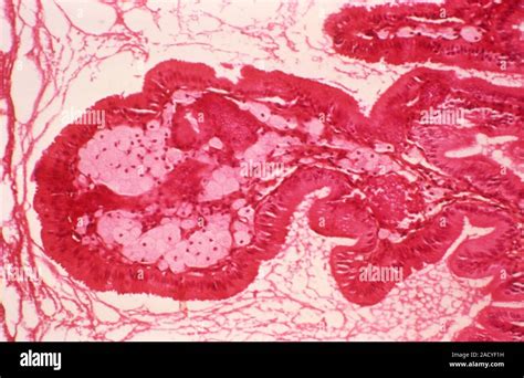 Gallbladder Cholesterolosis Light Micrograph Of A Section Through A