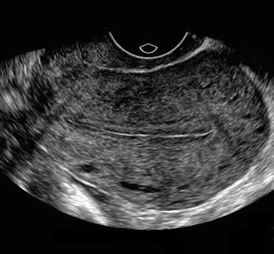 normal-proliferative-endometrium-1 – Obstetric and Gynecology ...