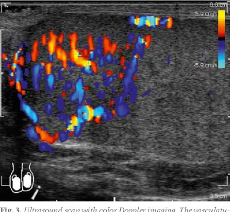 Figure 3 From Capillary Hemangioma Of The Testis A Case Report Of A