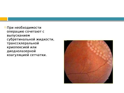 Отслойка сетчатки - презентация онлайн