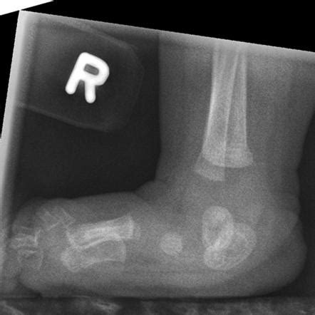 Rocker bottom feet | Radiology Case | Radiopaedia.org