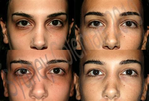 Dark Eyelids Before And After Eyesclinic