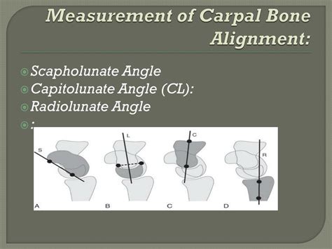 Ppt Carpal Instability Cid Powerpoint Presentation Free Download