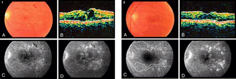 15 Anti Vegf Therapies In Diabetic Macular Edema Ento Key