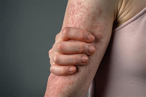 Understanding Psoriasis Symptoms Causes And Treatment Options