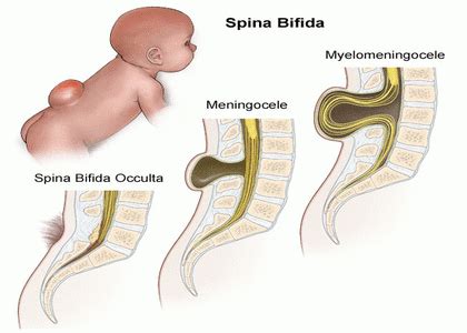 Spina Bifida Occulta Hair Patch