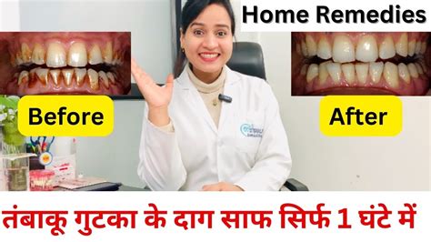 दाँतों से तंबाकू और गुटका के दाग घर पर कैसे साफ करें How To Remove