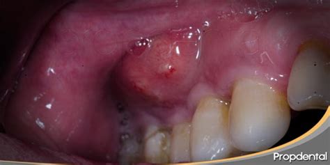 ¿que Es El Absceso Periapical ¿tienes Un Dolor Es Profundo Y Flemón