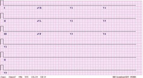 Asystole ECG | Learn the Heart