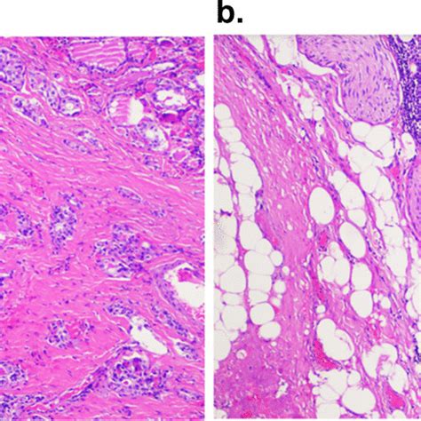 Final Pathology Demonstrating Papillary Thyroid Carcinoma A Focal