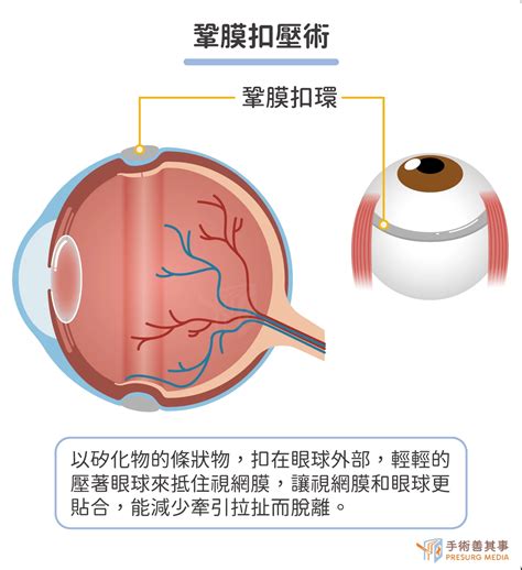 視網膜剝離症狀有哪些？前兆、症狀、自我檢查、原因、治療一次看