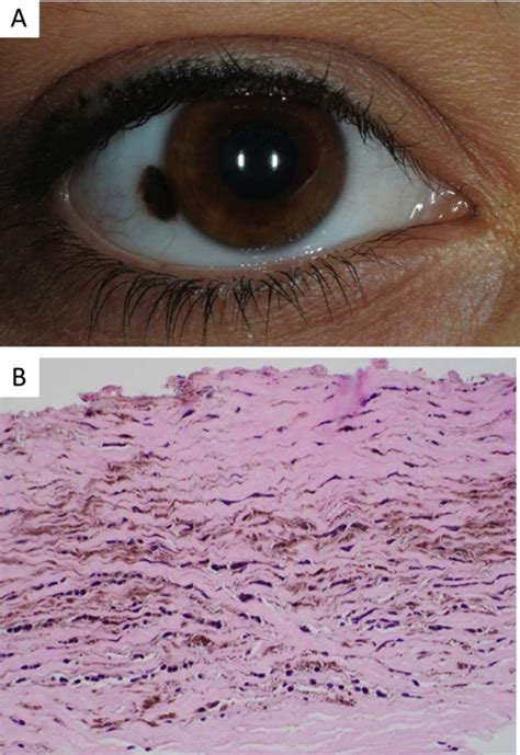 Conjunctival Blue Nevus A Clinical Photo Demonstrating Heterochromic