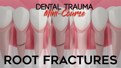 Dental Trauma Mini Course Part 6 Dental Trauma Guide Root