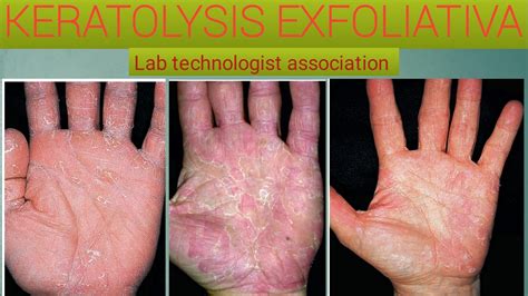 Everything You Know About Keratolysis Exfoliativa Youtube