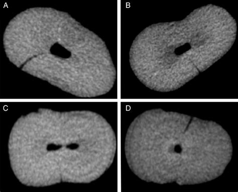 Micro Ct Images Showing Typical Preexisting Microcracks In Roots Of