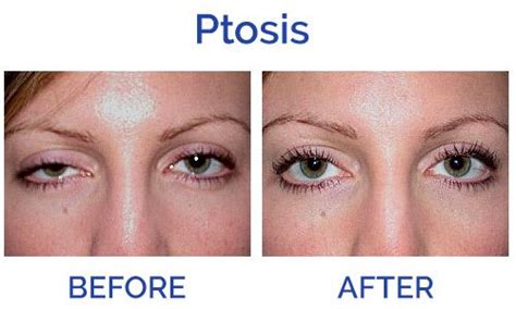 Ptosis Or Drooping Eyelid Symptoms Causes Diagnosis And Treatment