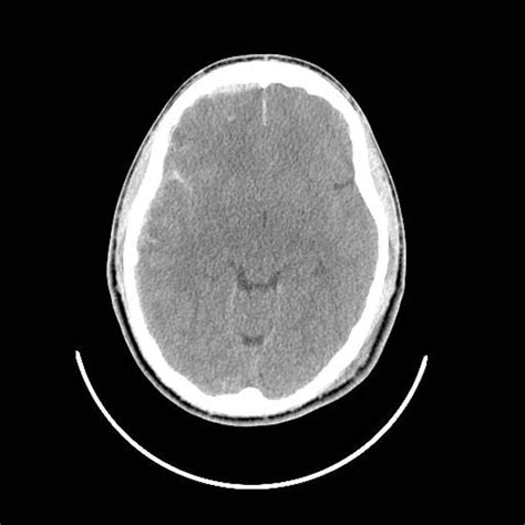 Subarachnoid Haemorrhage Radiology Reference Article Radiopaedia Org