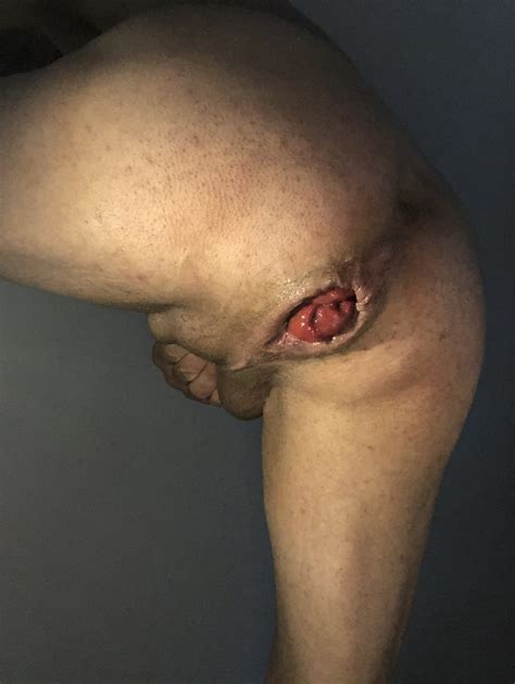 My Anal Prolapse Is Changing Incredibly Pics XHamster