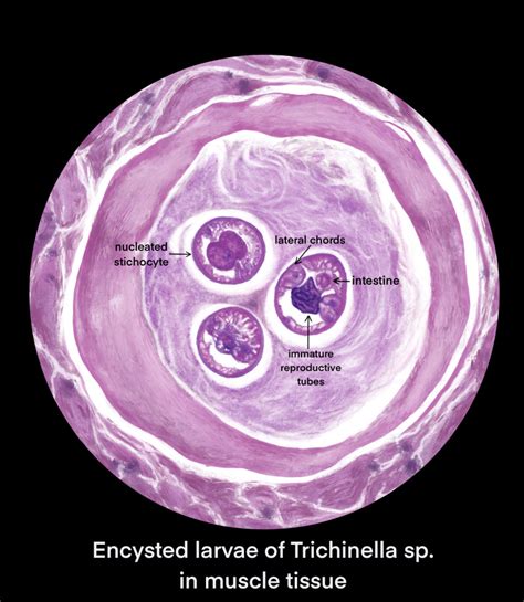 Figure Drawing Of Encysted Trichinella Larvae By Callahan Pels