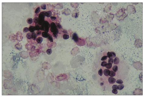 Relationship Between Radiological Stages And Prognoses Of Pneumocystis Pneumonia In Non Aids