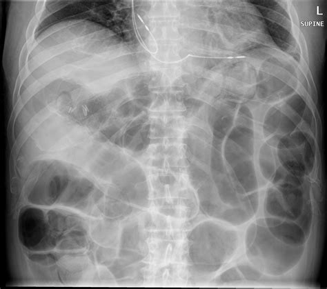 Rigler Sign And Pneumatosis Intestinalis Image