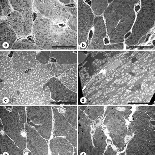 Treatment Of MCF In Estrogenized Female Nude Mice A Tumor
