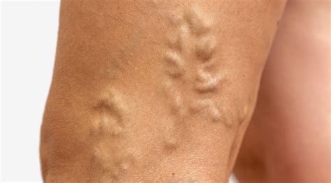 Varicose Veins London Vascular Clinic