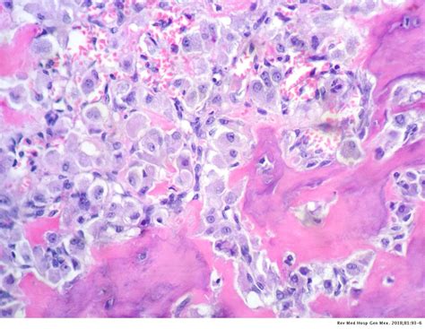 Osteoblastoma Histology