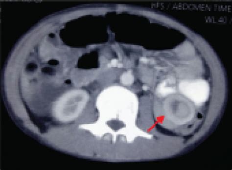 Computed Tomography Scan Demonstrates Jejunojejunal Intussusception