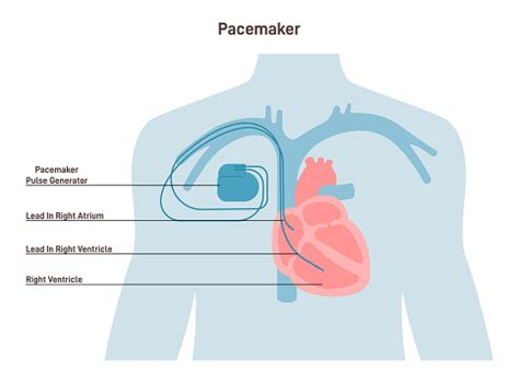 artificial cardiac pacemaker anatomical scheme medical device stock