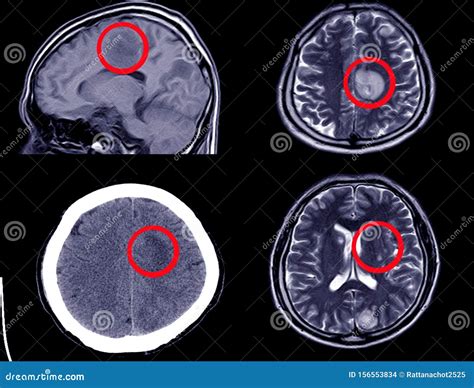 CT Scan Intracerebral Hemorrhage Stock Photography | CartoonDealer.com ...