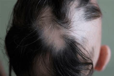 3 Signs Of Regrowth In Alopecia Areata Lady Alopecia