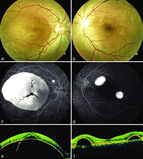 Pigment Epithelial Detachment