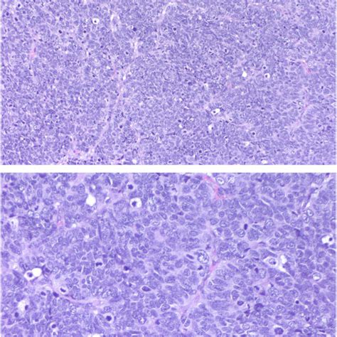 Prostatic Adenocarcinoma With Paneth Cell Like Differentiation Contains Download Scientific