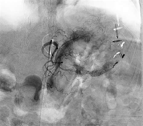 Gastric Necrosis And Perforation Following Treatment Of Dieulafoy’s Lesion With Embolization Of